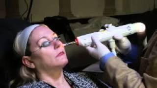 Treating Facial Vessels with David Goldberg, MD