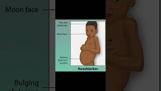 KWASHIORKOR