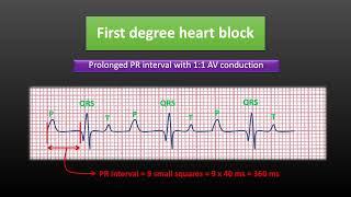 How to identify heart blocks on ECG | AV blocks on ECG | @LearningCardiology