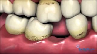 Patient Consent Implant Video Missing Teeth