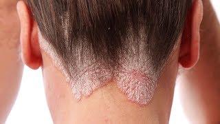 Can one go for ayurvedic treatment for Psoriasis?-Dr. Sharad Kulkarni