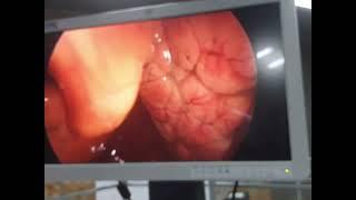 Hole in diaphragm - Adult Bochdalek Hernia #surgery