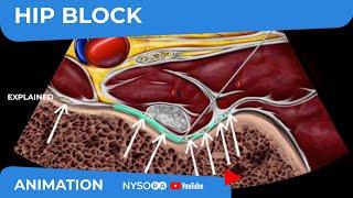 Hip Block - NYSORA's Reverse Ultrasound™ Animation