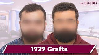 Best Results & Cost of Hair Transplant in Bangalore | Hair Transplant in Bangalore