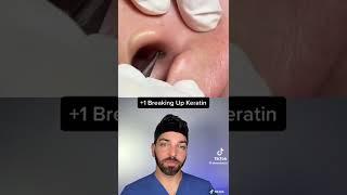 Blackhead inside ear removal! - Dermdoctor reacts (dr. Pimple popper)