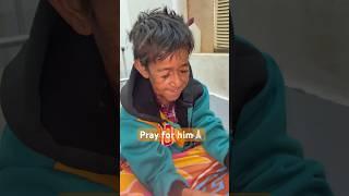 Progeria rare genetic disease | #prayforhim #ytshorts #rarediseases #Paa#amitabhbachchan#shorts