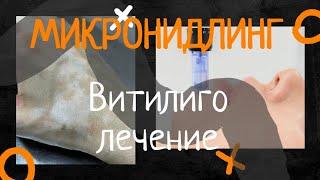 Лечение витилиго.  Микронидлинг.