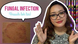 FUNGAL INFECTION TIH TUR LEH TIH LOH TUR TE/ Dr Nancy Dermatologist