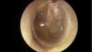 Serous Otitis Media