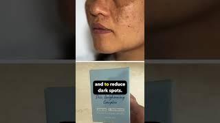 My favourite solutions melasma, strawberry skin, sunscreen| Dr. Sarin |