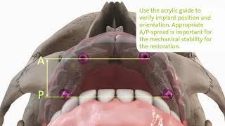 Straumann® ProArch with BLX Implant System