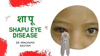 SHAPU EYE DISEASE