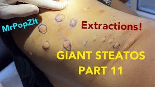 Extractions! Giant STEATOS, blackheads, vellus hairs, ingrown hairs, this one has it all! POPS!