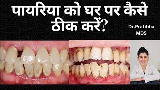 पायरिया को घर पर कैसे ठीक करें? Pyorrhoea- it’s cause , Home remedies n Treatment-Dr.Pratibha MDS