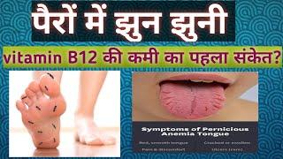 पैरों में झुन झुनी vitamin B12 की कमी का पहला संकेत? vitamin B12 deficicency cuses symptoms treatmen