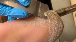 Callus removal from feet&Foot scraping dead skin【Xiao Yan pedicure】#stress  1112