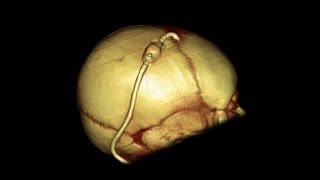 VP Shunt in Hydrocephalus. Part- 4 (Dr. Sudipta Kumer Mukherjee)