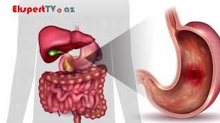 Mədə xorası nədir və əlamətləri nələrdir?
