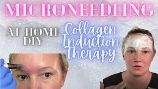 Microneedle at Home | DIY Collagen Induction Therapy | Selfcare Sunday