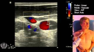 JVP (Jugular Venous Pulsation) Evaluation using Ultrasound