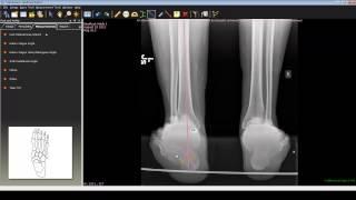 Foot and Ankle Deformity Correction with Dr. Noman Siddiqui - Hindfoot Varus Deformity