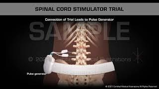 Spinal Cord Stimulator (SCS) Trial