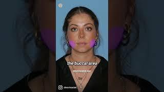 Facial Contouring 1 Week Results #plasticsurgery #cosmeticsurgery #liposuction #snatched