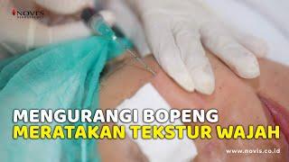 Atasi Bopeng Bekas Jerawat & Meratakan Tekstur Kulit || NOVI'S