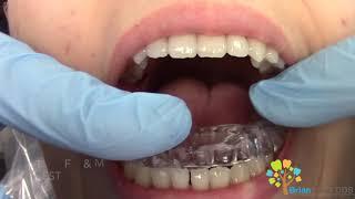 Night Guard for teeth ️ -How it's made and fitted.