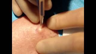 Skin surgery - epidermoid (sebaceous) cyst removal 1