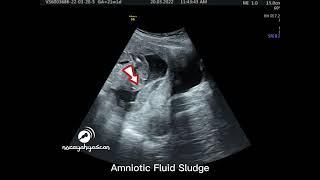 Amniotic Fluid Sludge