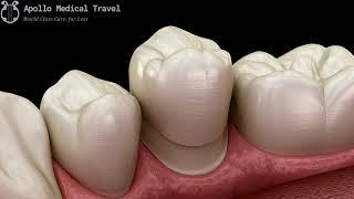 Animated Dental Crown Procedure | Apollo Medical Travel