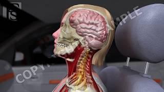 Car Accident Whiplash and Brain Damage Low Speed