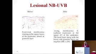 Combination of Acitretin and Narrowband UV-B for the Treatment of Vitiligo: