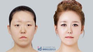 Let Me In Korea Plastic Surgery  | Facial Bone Surgery, Forehead Augmentation