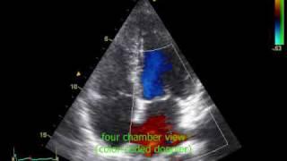 echocardiography with sound and arrhythmia