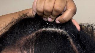 Dandruff Scratching | Scalp Picking and Greasing Itchy Dry Scalp