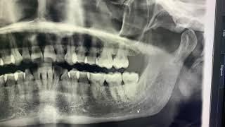 Distoangular Impacted Third Molar | Wisdom Tooth Extraction