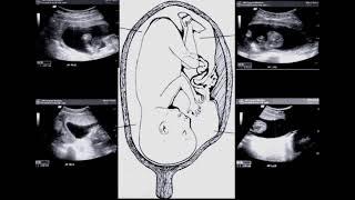 Sonography - Fetal Genitourinary System