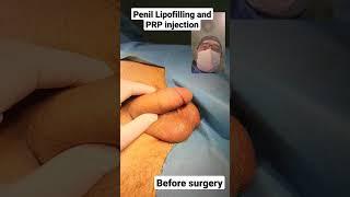 Penil lipofilling and PRP injection by Dr Araz Bayramov #penil #penis penilenlargement.com