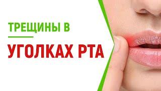 Трещины в уголках рта: ТОП методов лечения, причины появления