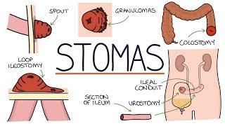 Understanding Stomas (Colostomy, Ileostomy, Urostomy and Gastrostomy)