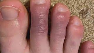 What are COVID toes?