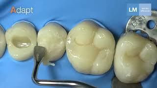 LM-Arte™ Replica Posterior for occlusal modeling with simple steps (long version)