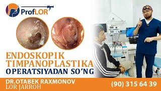 #Natija bemorimiz #EndoskopikTimpanoplastika operatsiyasidan so'ng