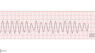 Ventricular Flutter