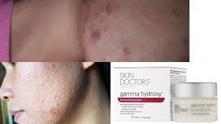 Skin Doctors Gamma Hydroxy+Forte Before and after Result| Acne/Pimple journey| Skin Care