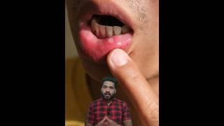 4 Home remedies for mouth ulcers! मुँह के छाले घर पर ठीक करें #shorts