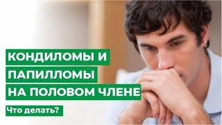 Кондиломы и папилломы на половом члене: что делать?