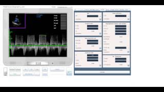 Assessment of Aortic regurgitation by PHT. Echocardiography online simulator